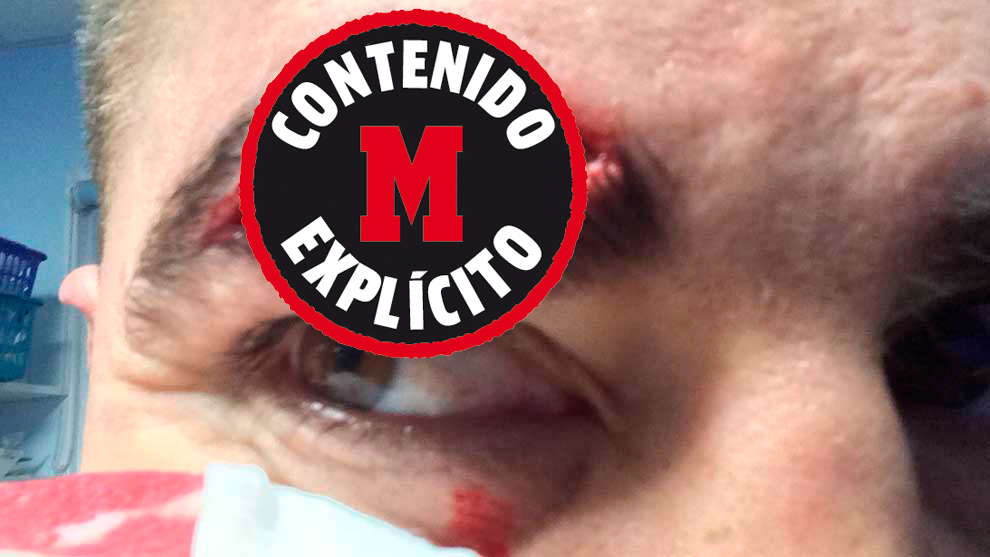 Profunda brecha en la ceja de Dan Leo