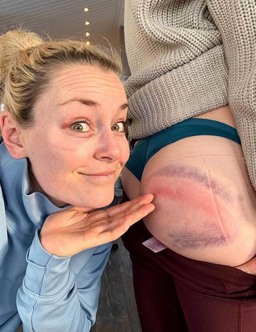 Lindsey Vonn mostrando su ojo amoratado tras su tremenda ca�da y...