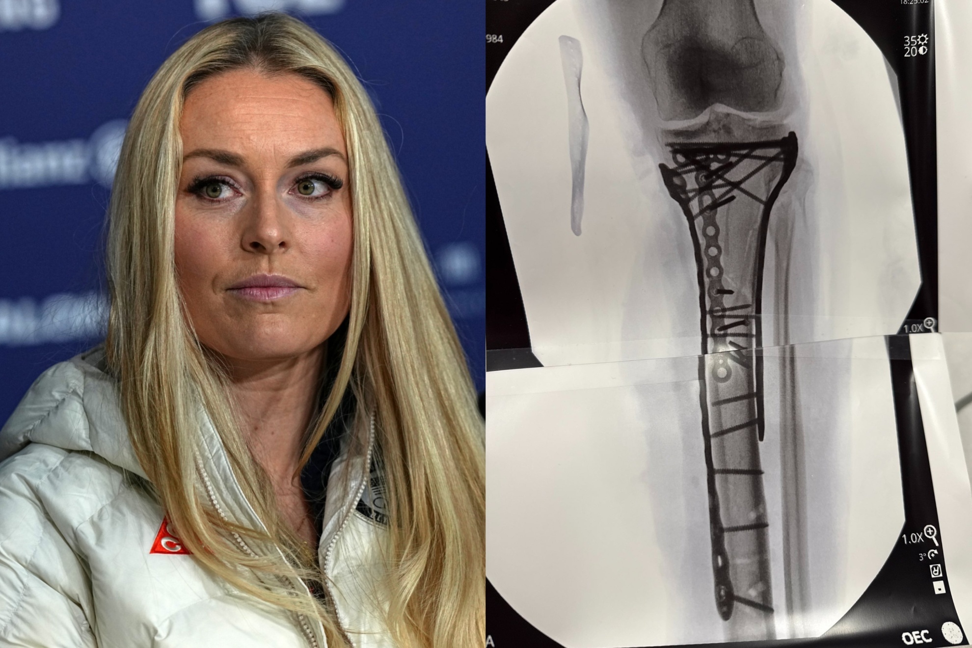 NFL injury expert warns of grim outlook after Lindsey Vonns Olympic ski crash.