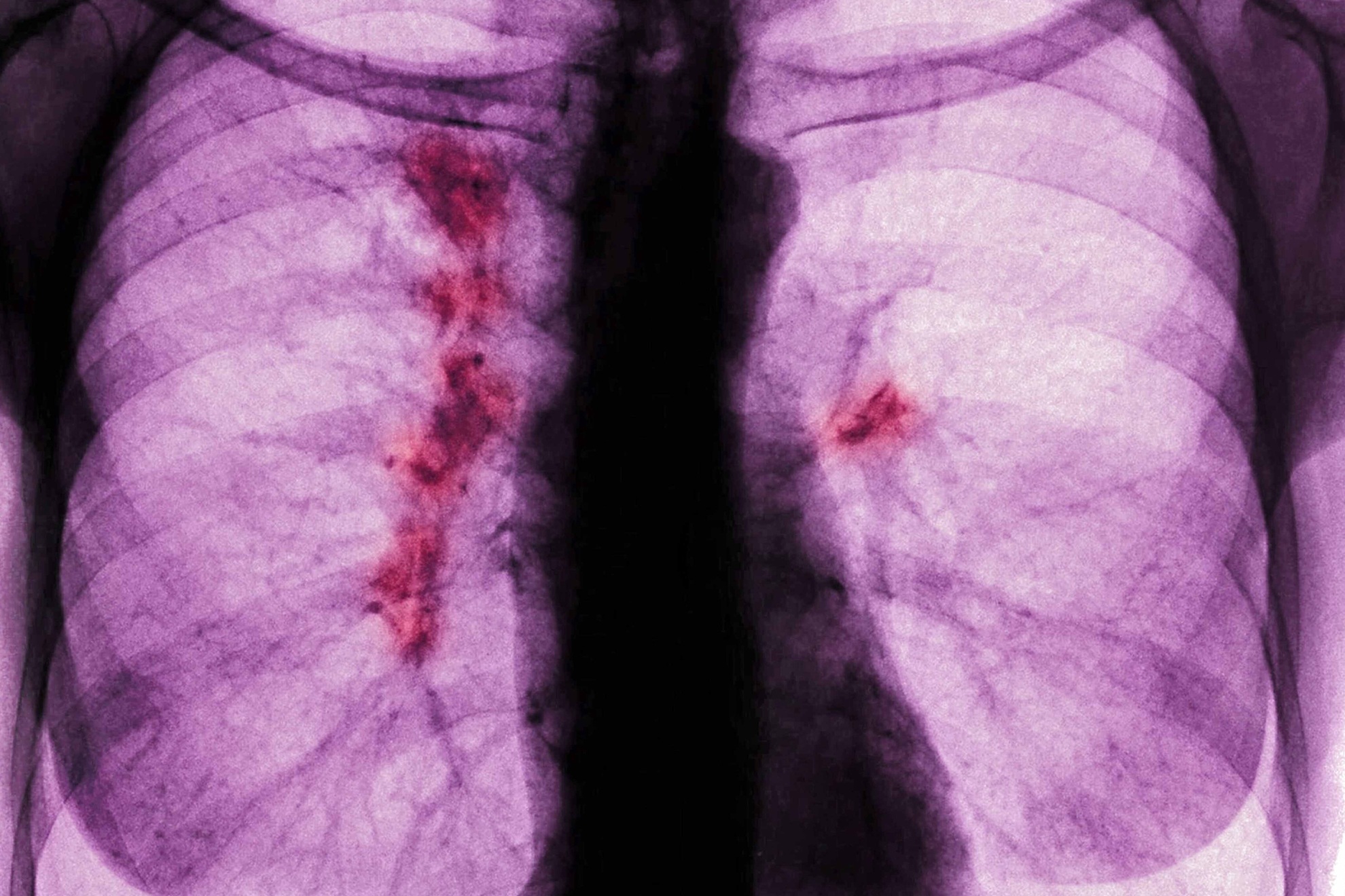 El hallazgo que desconcierta a los investigadores: más frutas y verduras en pacientes jóvenes con cáncer de pulmón