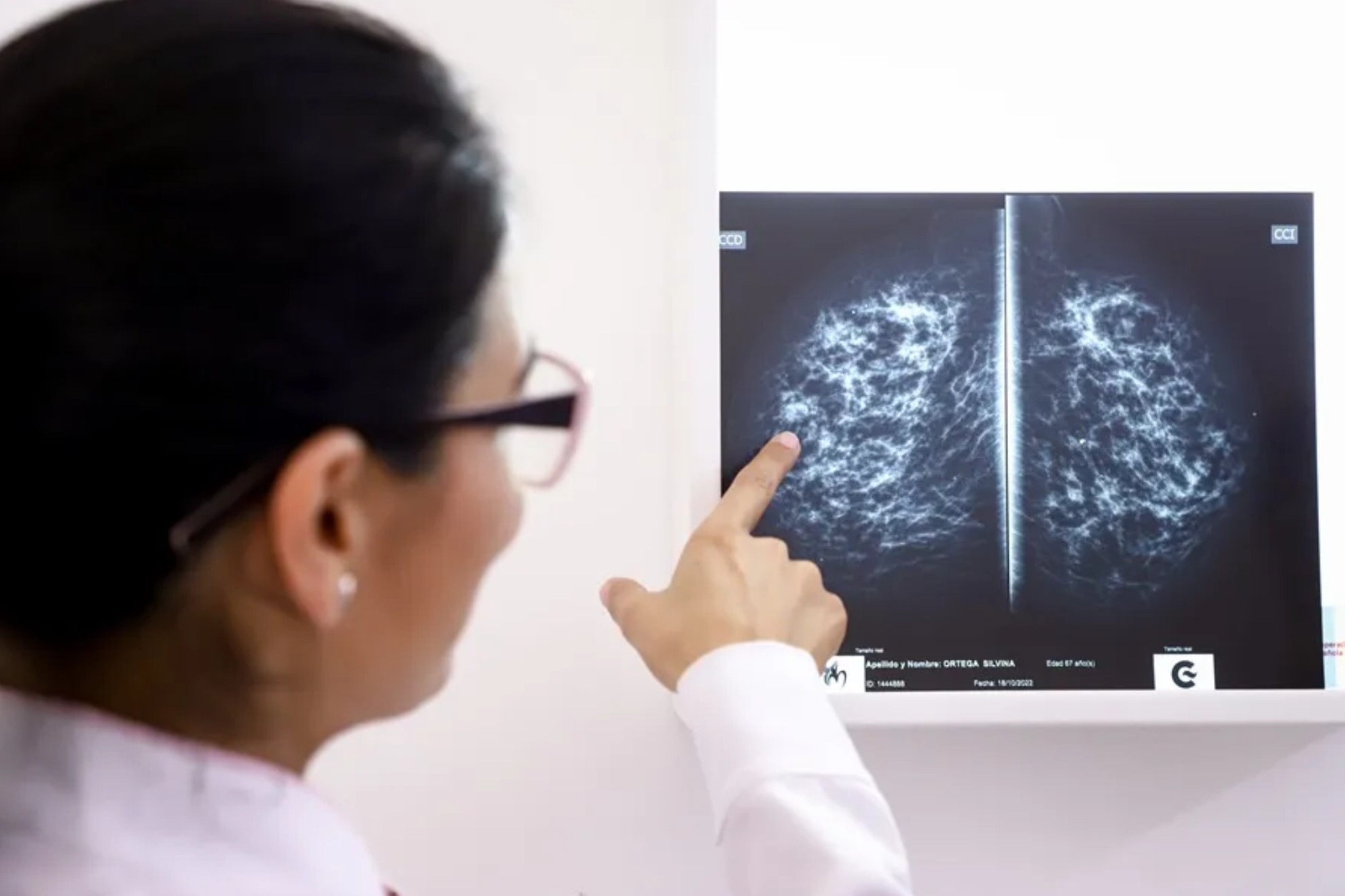 Un estudio científico confirma que existe relación entre los niveles de vitamina D y el cáncer de mama
